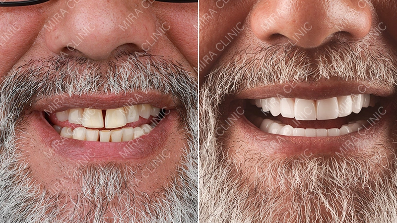  Hollywood Smile Reviews – Final Results
